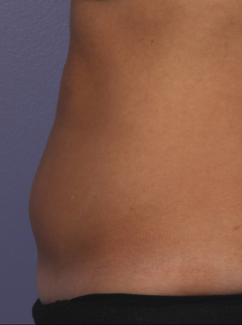 CoolSculpting by Zeltiq to abdomen after 375503