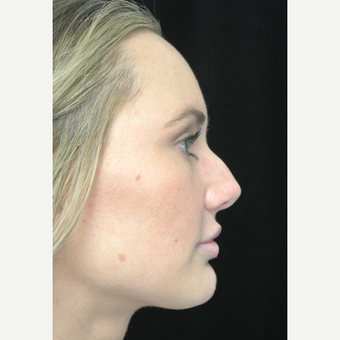Scarless Closed Rhinoplasty before 3586256