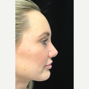 Scarless Closed Rhinoplasty after 3586256