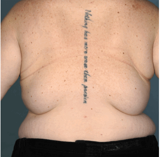 Back Lift/ Bra Roll Lift before 1143514