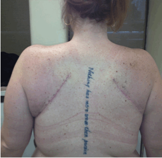 Back Lift/ Bra Roll Lift after 1143514
