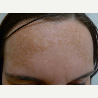 25-34 year old woman treated with Melasma Treatment before 1584555