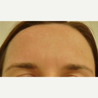 25-34 year old woman treated with Melasma Treatment after 1584555