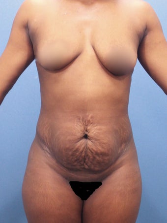 Tummy Tuck before 2526093