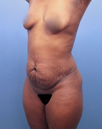 Tummy Tuck 2526093