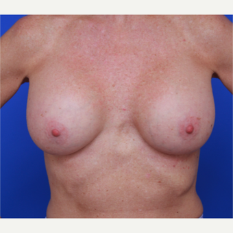 51- year old woman treated with Breast Implants after 3787618