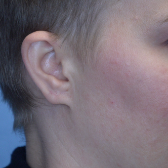 12-34 year old woman treated with an Ear Gauge Repair after 3253367