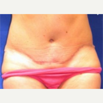 45-54 year old woman treated with Tummy Tuck after 3009797