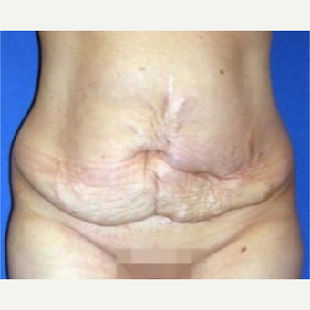 45-54 year old woman treated with Tummy Tuck before 3009797