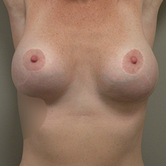 35-44 year old woman treated with Breast Implant Revision after 2853007