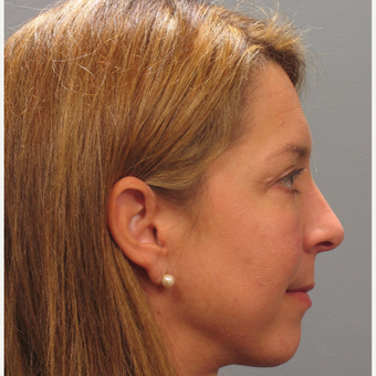 45-54 year old woman treated with Eyelid Surgery after 3506198