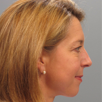 45-54 year old woman treated with Eyelid Surgery before 3506198