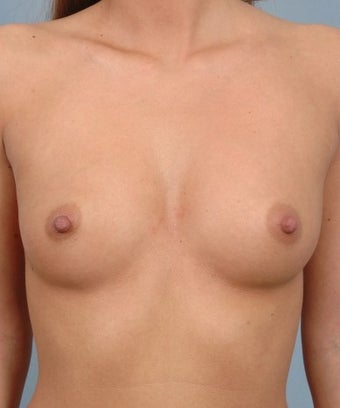 Breast Augmentation- Asymmetric Breasts before 1268313