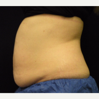 35-44 year old woman treated with CoolSculpting before 3679848