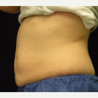 35-44 year old woman treated with CoolSculpting after 3679848
