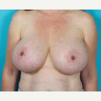 46 year old woman treated with Breast Implant Removal and Mastopexy 5 months post-op before 2227605