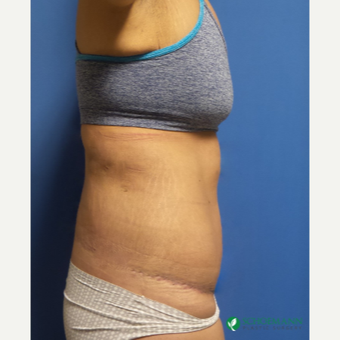 18-24 year old woman treated with Body Lift after 3253876