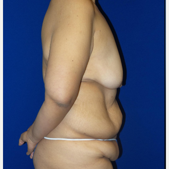 18-24 year old woman treated with Body Lift before 3253876