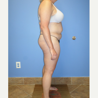35-44 year old woman treated with Weight Loss before 3370185