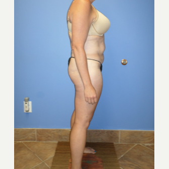 35-44 year old woman treated with Weight Loss after 3370185