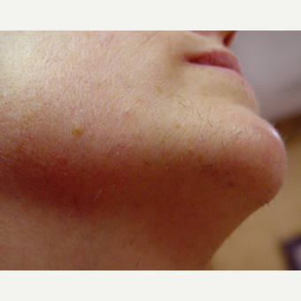 44 Year Old Woman Treated With Laser Hair Removal before 2057860