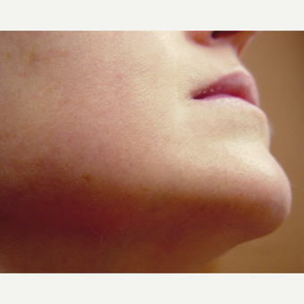 44 Year Old Woman Treated With Laser Hair Removal after 2057860