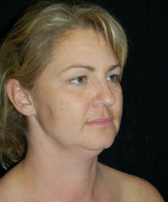 Cheek Fat Pad Removal before 902796