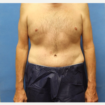 45-54 year old man treated with Tummy Tuck after 3531583
