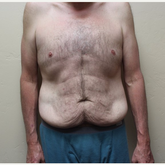 45-54 year old man treated with Tummy Tuck before 3531583