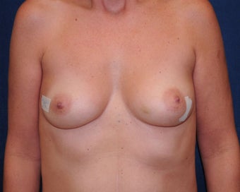 immediate bilateral mastectomy and immediate reconstruction before 692749