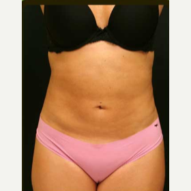 Liposuction of abdomen and flanks after 3122678