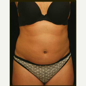 Liposuction of abdomen and flanks before 3122678