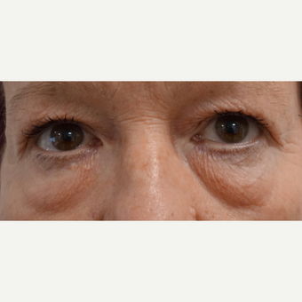 55-64 year old woman treated with Eye Bags Treatment before 3479798