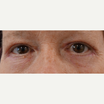55-64 year old woman treated with Eye Bags Treatment after 3479798