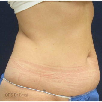 45-54 year old woman treated with Liposuction before 3305930