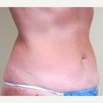 45-54 year old woman treated with Liposuction after 3305930