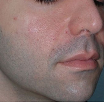 Young Male Treated for Nasolabial Folds and Cheek Volume after 1367276