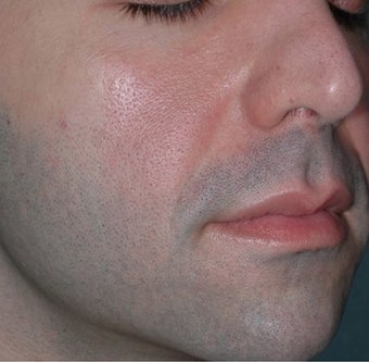 Young Male Treated for Nasolabial Folds and Cheek Volume before 1367276