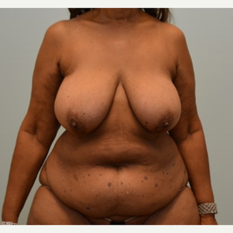 Tummy tuck, liposuction, and enhanced breast lift (“autoaugmentation”) on 64 year old patient before 2372526