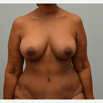 Tummy tuck, liposuction, and enhanced breast lift (“autoaugmentation”) on 64 year old patient after 2372526