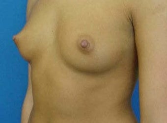 Breast Augmentation (Transaxillary) before 316999