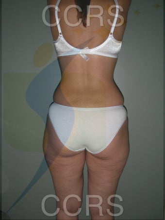 VASER lipo - 28 yrs. old (abdomen, back, flanks & thighs) 636166