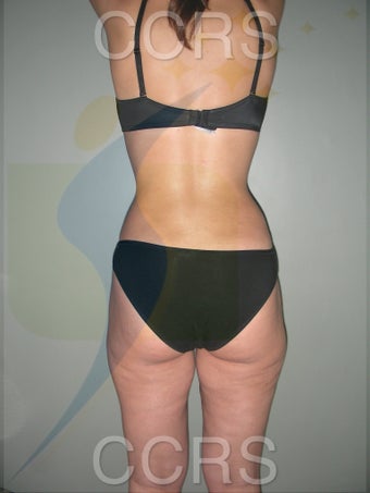 VASER lipo - 28 yrs. old (abdomen, back, flanks & thighs) 636166