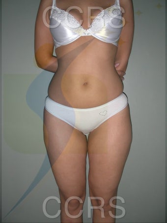 VASER lipo - 28 yrs. old (abdomen, back, flanks & thighs) before 636166