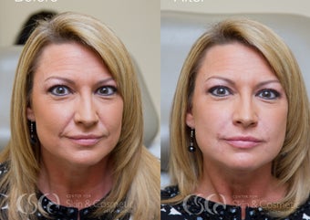 Female treated for nasolabial folds before 1090001