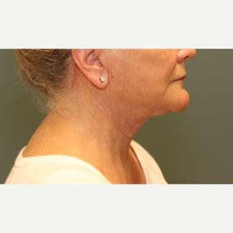 55-64 year old woman requesting Neck Lift after 3031332