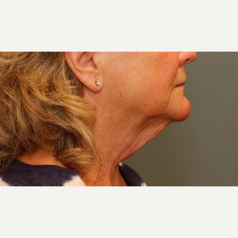 55-64 year old woman requesting Neck Lift before 3031332