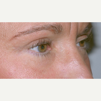 Eyelid Surgery after 3346329
