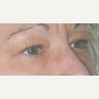 Eyelid Surgery before 3346329