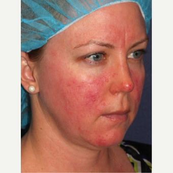 25-34 year old woman treated with IPL before 3110254